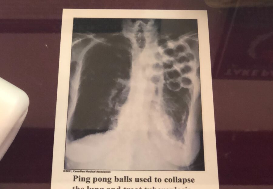 a historic X-ray of a lung filled with ping-pong balls